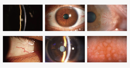 Mocular SL-350D Digital Slit Lamp - img sample